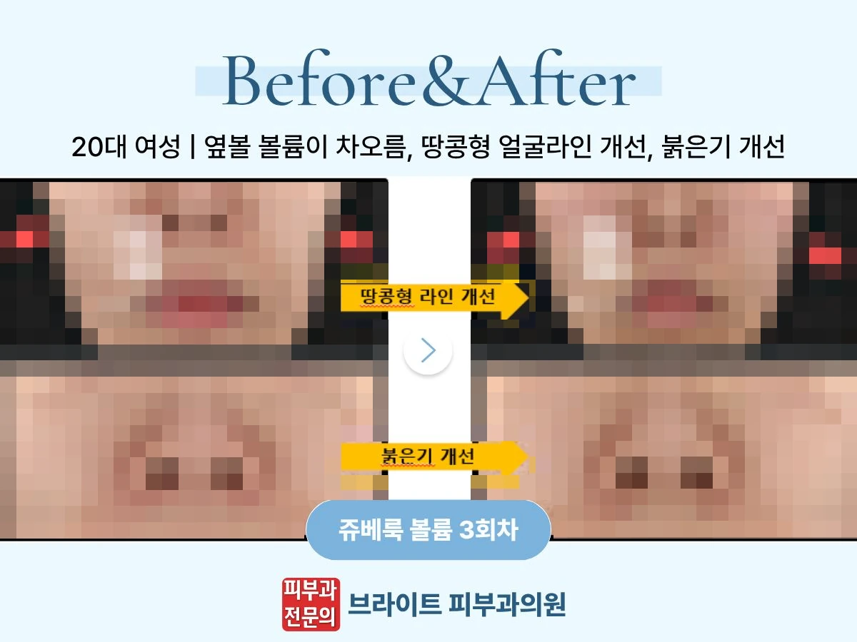 20대 여성의 쥬베룩 볼륨 3회차 전후 비교 포스터, 환자 사진 영역 모자이크 처리