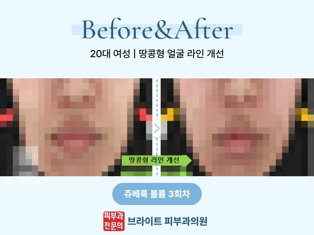 20대 여성의 쥬베룩 볼륨 3회차 얼굴 라인 전후 비교 포스터, 환자 사진 영역 모자이크 처리